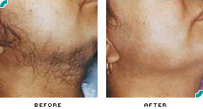 Laser therapy for hirsutims