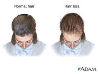 Female Hair Loss and PCOS: Find Out What's Causing Your Hair to Fall Out.