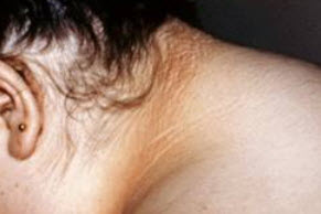 Acanthosis Nigricans pic